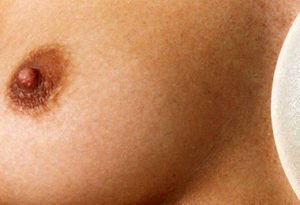 Chirurgie esthétique des seins à Lyon - L'aréole - Dr Corniglion