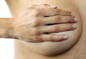 Lifting des seins - Ptôse mammaire - Dr Corniglion