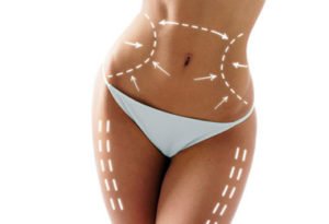 Lipoaspiration ou liposuccion à Lyon - Dr Corniglion