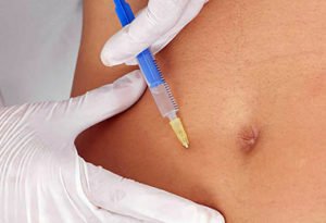 Lipomodelage lipofilling à Lyon - Dr Corniglion