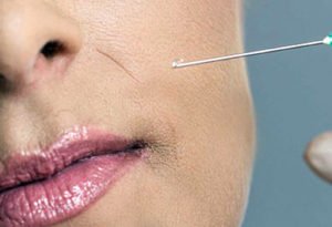 Liposeeding à Lyon, Dr Corniglion, médecin esthétique