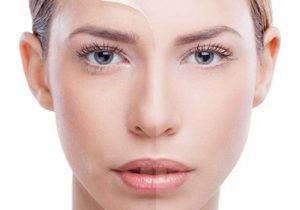 Mesothérapie Mésolift à Lyon - Dr Corniglion