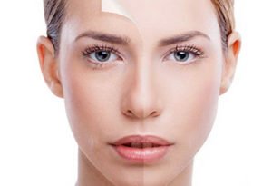 Mesothérapie Mésolift à Lyon - Dr Corniglion