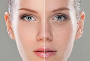 Peeling du visage à Lyon - Dr Corniglion