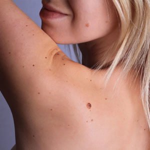 Chirurgie cutanée à Lyon - Dr Corniglion