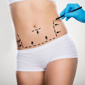 Abdominoplastie ou lifting du ventre à Lyon - Dr Corniglion