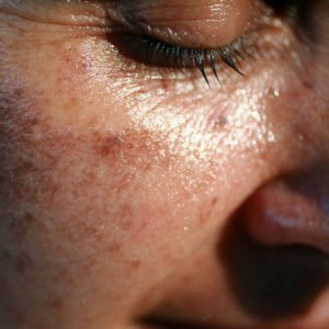 Traitement des taches pigmentaires à Lyon - Dr Corniglion