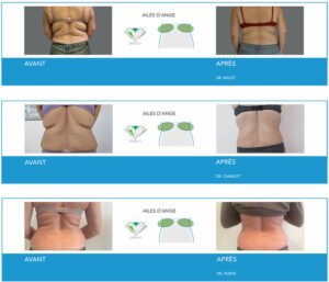 Cryolipolyse à Lyon - Avanat / Après Ailes d'ange - Dr Corniglion