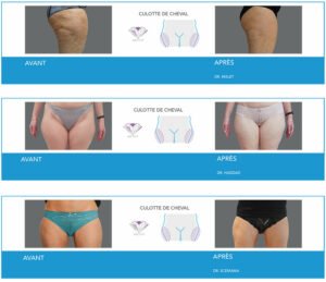 Cryolipolyse à Lyon - Avanat / Après culotte de cheval - Dr Corniglion
