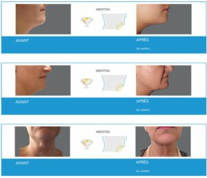 Cryolipolyse à Lyon - Avanat / Après menton - Dr Corniglion