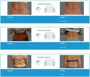 Cryolipolyse à Lyon - Avanat / Après poignée d'amour- Dr Corniglion