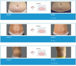 Cryolipolyse à Lyon - Avanat / Après ventre - Dr Corniglion