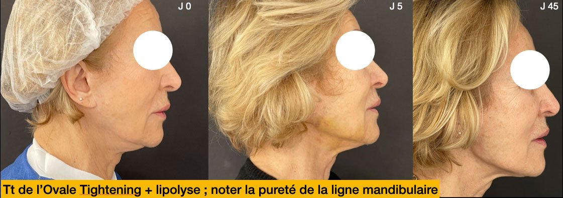 Traitement relachement cutané à Lyon chez le dr Corniglion