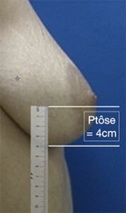 Chiffrer ptose mammaire lyon par le dr Corniglion