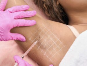 Toxine botulique à Lyon contre l'hyperhidrose